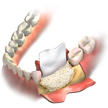 Bow Trail SW Bone Grafting | Nova Dental Care | General & Family Dentist | Bow Trail | SW Calgary