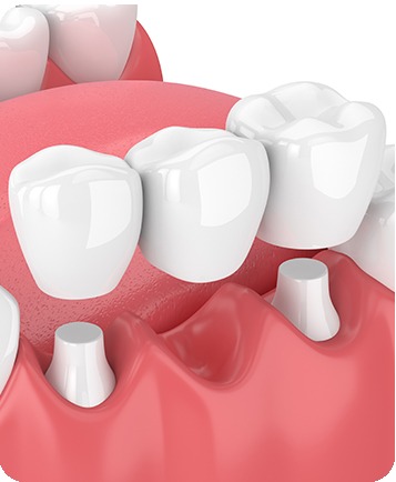 Bow Trail SW Dental Bridges | Nova Dental Care | General & Family Dentist | Bow Trail | SW Calgary