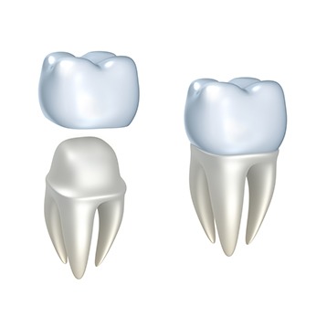 Bow Trail SW Dental Crowns | Nova Dental Care | General & Family Dentist | Bow Trail | SW Calgary