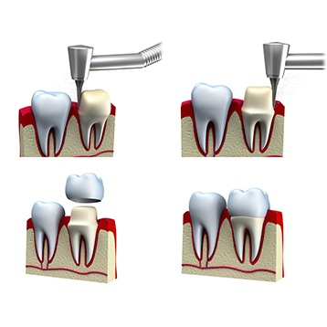 Bow Trail SW Dental Crowns | Nova Dental Care | General & Family Dentist | Bow Trail | SW Calgary