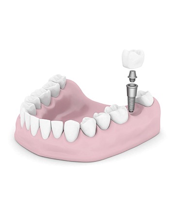 Bow Trail SW Dental Implants | Nova Dental Care | General & Family Dentist | Bow Trail | SW Calgary