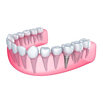 Bow Trail SW Dental Implants | Nova Dental Care | General & Family Dentist | Bow Trail | SW Calgary