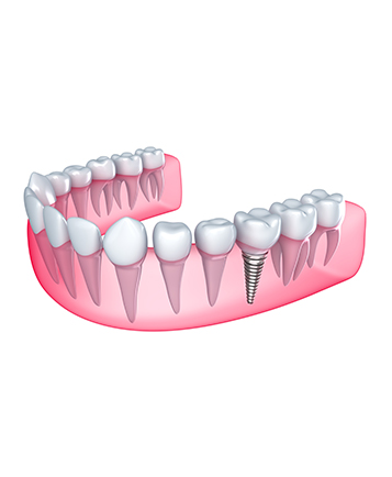 Bow Trail SW Implant Dentistry | Nova Dental Care | General & Family Dentist | Bow Trail | SW Calgary