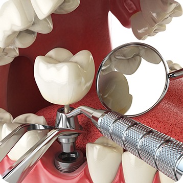 Bow Trail SW Implant Placement Surgery | Nova Dental Care | General & Family Dentist | Bow Trail | SW Calgary