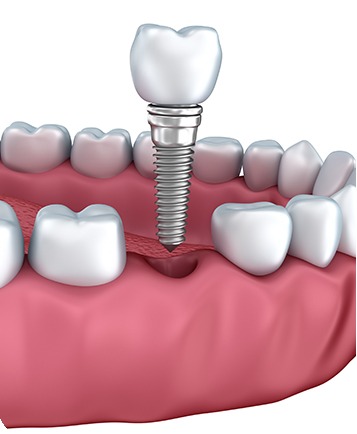 Bow Trail SW Implant Placement Dentistry | Nova Dental Care | General & Family Dentist | Bow Trail | SW Calgary