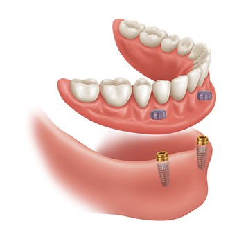 Bow Trail SW Implant Supported Dentures | Nova Dental Care | General & Family Dentist | Bow Trail | SW Calgary