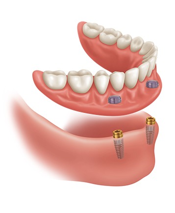 Bow Trail SW Implant Supported Dentures | Nova Dental Care | General & Family Dentist | Bow Trail | SW Calgary