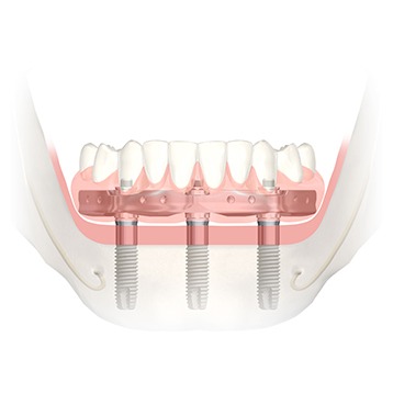 Bow Trail SW Over Denture Implants | Nova Dental Care | General & Family Dentist | Bow Trail | SW Calgary