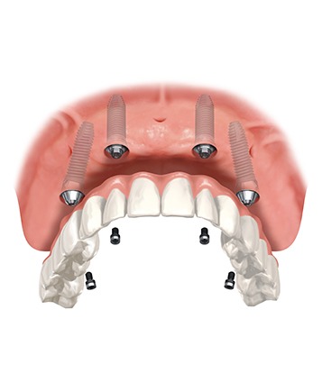 Bow Trail SW Over Implant Dentures | Nova Dental Care | General & Family Dentist | Bow Trail | SW Calgary