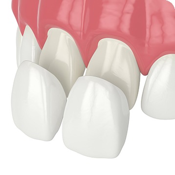Bow Trail SW Porcelain Veneers | Nova Dental Care | General & Family Dentist | Bow Trail | SW Calgary