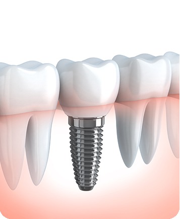 Bow Trail SW Restorative Dentistry | Nova Dental Care | General & Family Dentist | Bow Trail | SW Calgary