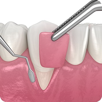 Bow Trail SW Soft Tissue Grafting | Nova Dental Care | General & Family Dentist | Bow Trail | SW Calgary