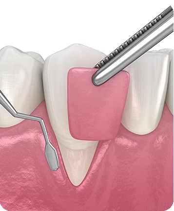 Bow Trail SW Soft Tissue Grafting | Nova Dental Care | General & Family Dentist | Bow Trail | SW Calgary