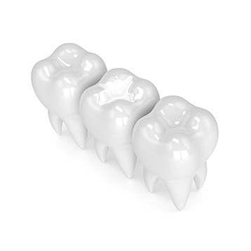 Bow Trail SW Tooth Coloured Fillings | Nova Dental Care | General & Family Dentist | Bow Trail | SW Calgary