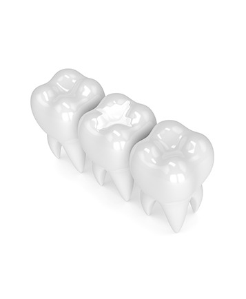 Bow Trail SW Tooth Coloured Fillings | Nova Dental Care | General & Family Dentist | Bow Trail | SW Calgary