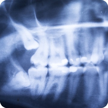 Bow Trail SW Wisdom Teeth Extraction | Nova Dental Care | General & Family Dentist | Bow Trail | SW Calgary
