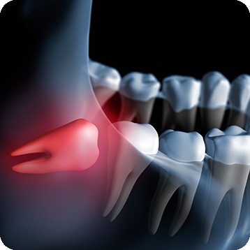 Bow Trail SW Wisdom Teeth Extraction | Nova Dental Care | General & Family Dentist | Bow Trail | SW Calgary